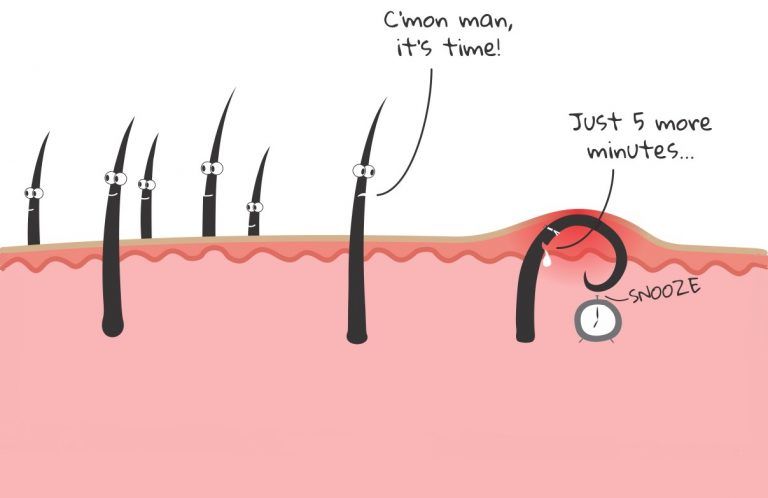 Causes of ingrown hair