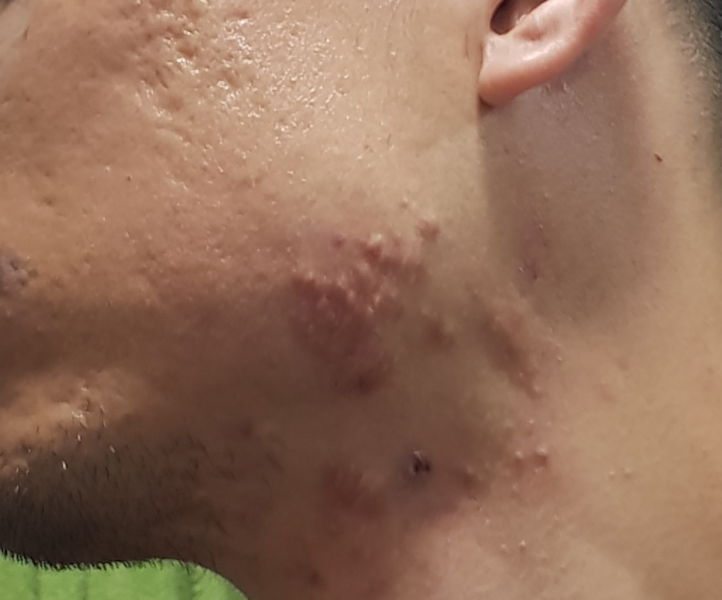 Hypertrophic scars acne 2