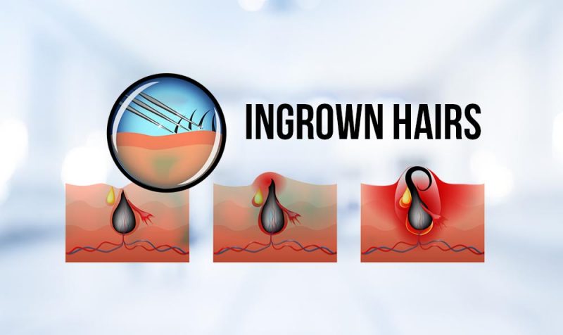 Ingrown-Hairs