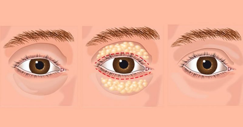 Natural-Ways-to-Get-Rid-of-Eye-Bags