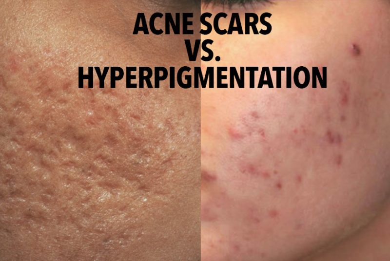 Post Inflammatory Hyperpigmentation