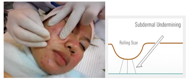 Subcutaneous Incision 2