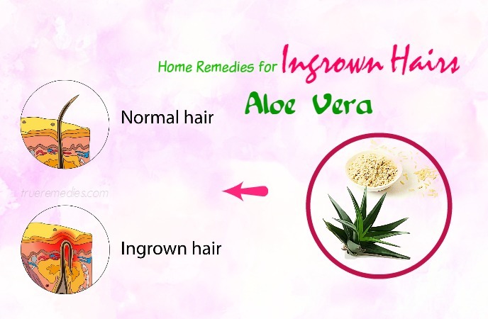 home-remedies-for-ingrown-hairs-aloe-vera