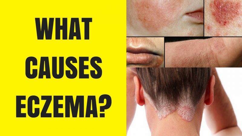 Causes of eczema