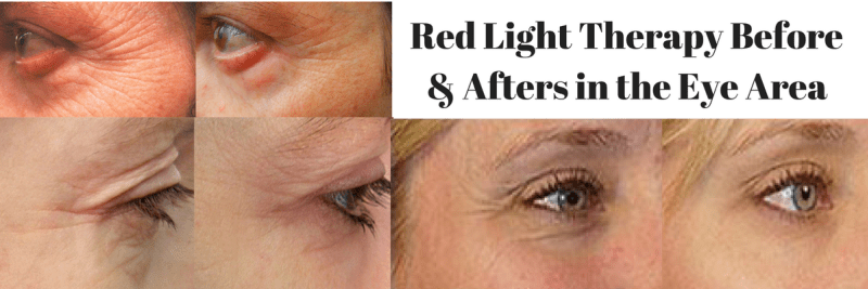 Red-Light-Therapy-Before-Afters-in-the-Eye-Area