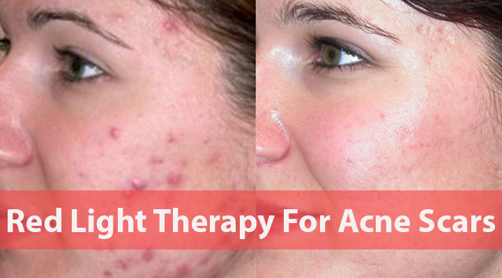 Red-Light-Therapy-For-Acne-Scars