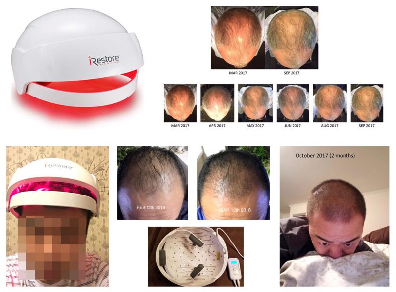 iRestore-Laser-Hair-Growth