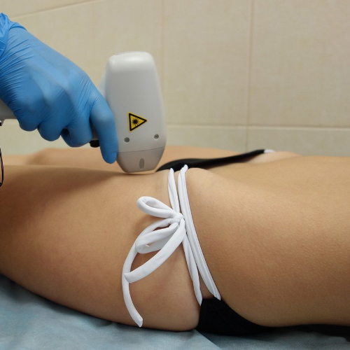 bikini-line-laser-hair-removal